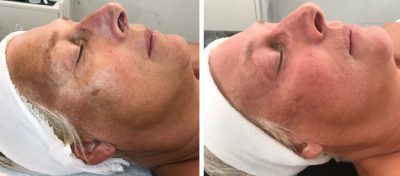 BioPulse Therapy