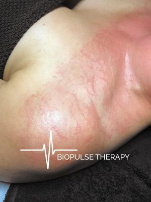 BioPulse Therapy