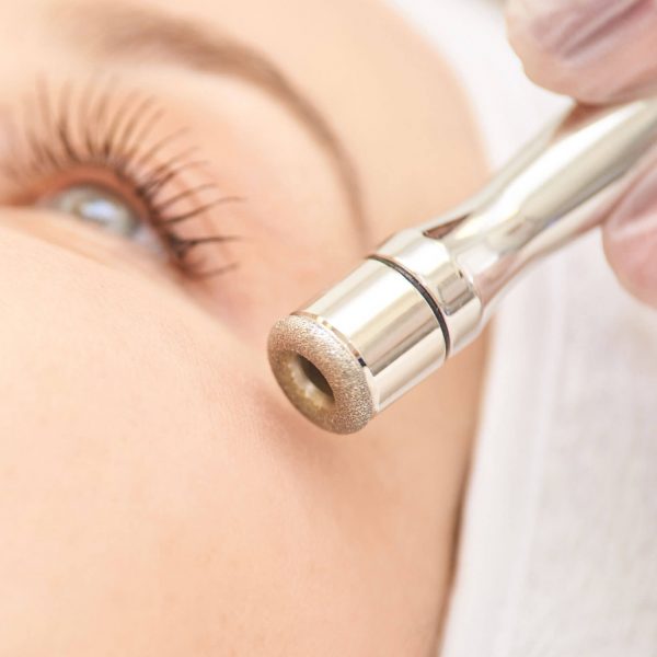 Microdermabrasie